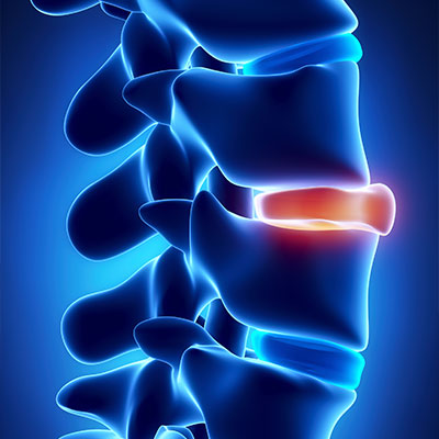Slipped Disc Treatment in Overland Park
